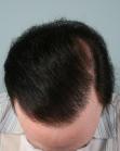 After Hair Transplant&nbsp;Revision